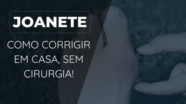 Joanetes: Como Corrigir em Casa SEM Cirurgia